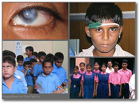 Более 50 процентов случаев слепоты у детей в Индии поддается лечению.