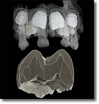 Визуализация при помощи синхротронного излучения зубов неандертальца. Судя по линиям роста, зуб, показанный внизу, принадлежит неандертальцу, дожившему лишь до трехлетнего возраста.